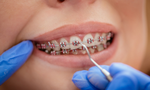 Kiedy można założyć pierwszy aparat ortodontyczny?